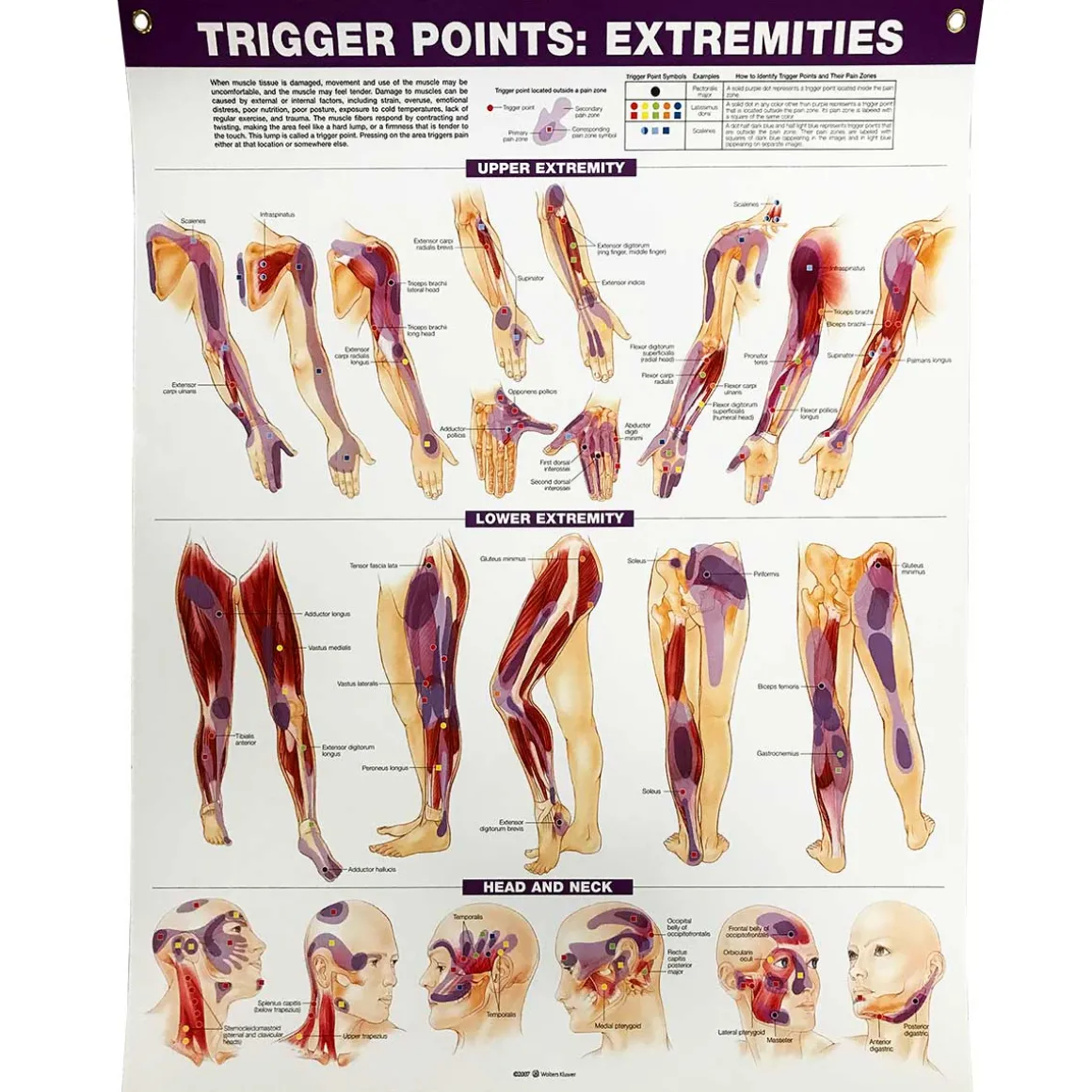 Trigger Points: Extremities Chart